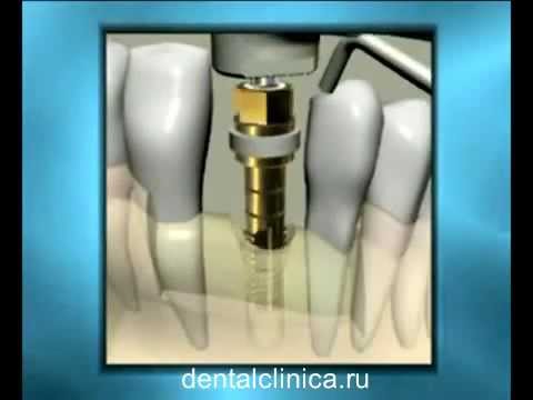 Лечение зубов имплантация hi-tech в Москве Санкт-Петербурге протезирование стоматология