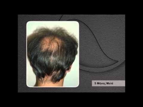 Лечение выпадения волос PRP в клинике волос BERGMANN KORD