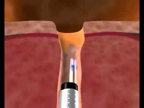 Лазерная вапоризация аденомы предстательной железы