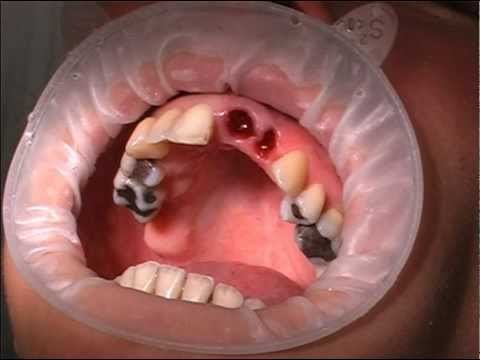 Боли после удаления зуба - Альвеолит