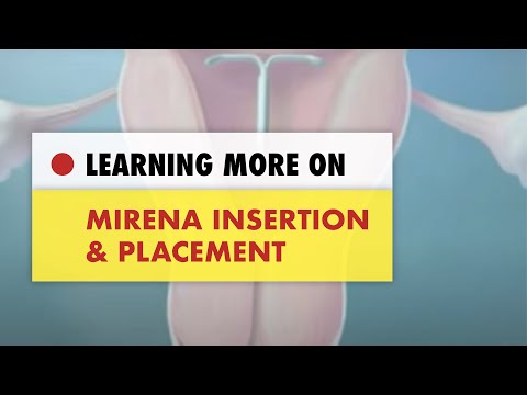 Mirena Insertion and Placement