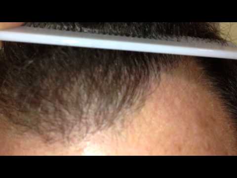Natural Hair Line Dr. Panno Hair Transplant Marbella пересадка волос лечения выпадения волос