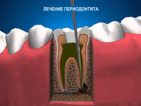 Терапевтическая стоматология Лечение периодонтита