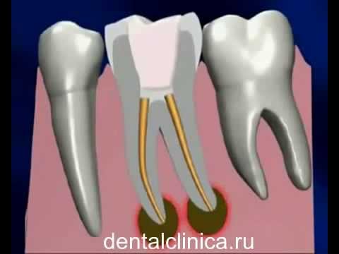 Лечение зубов красивая улыбка протезирование имплантация European Clinic of Aesthetic Dentistry
