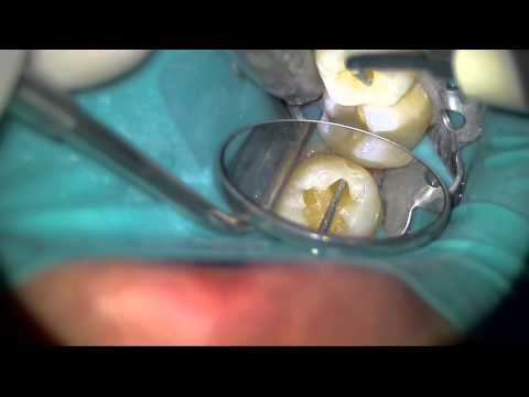 Глубокий кариес зуб 4.6 лечение под микроскопом