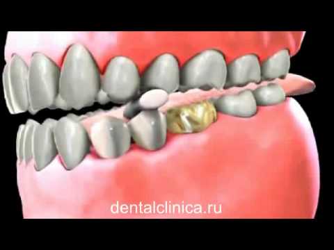 Протезирование зубные мосты функциональная стоматология European Clinic of Aesthetic Dentistry