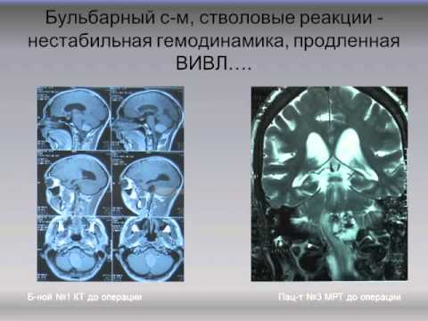 Лечение и мониторинг при операциях на опухолях головного мозга Савин И.А.