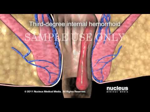 Операция удаления геморроя, геморроидэктомия/Hemorrhoidectomy Hemorrhoid Surgery