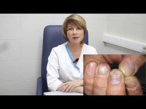 Онихомикоз. Грибок ногтей лечение. дельта клиник