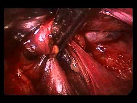 Эндоскопическое удаление паращитовидной железы слева