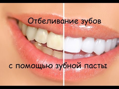 Отбеливание зубов в стоматологии для любых зубов