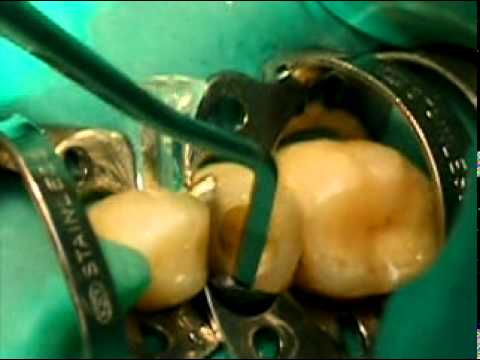 Лечение глубокого кариеса, реставрация зуба