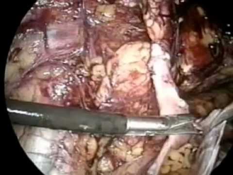 Герниопластика (хирургическое лечение грыж)