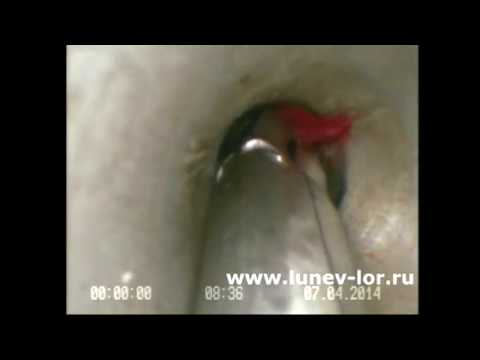 Удаление кисты верхнечелюстной пазухи (эндоскопическая часть операции)